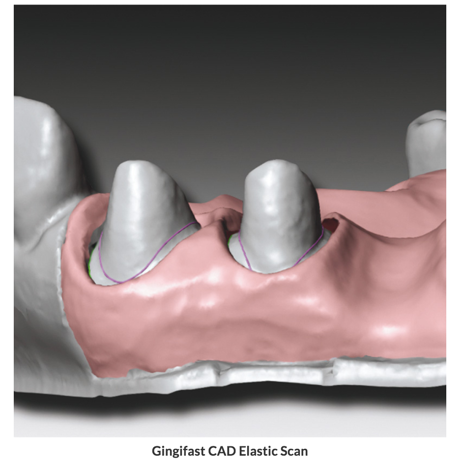 Gingifast CAD (Elastico/Rigido)