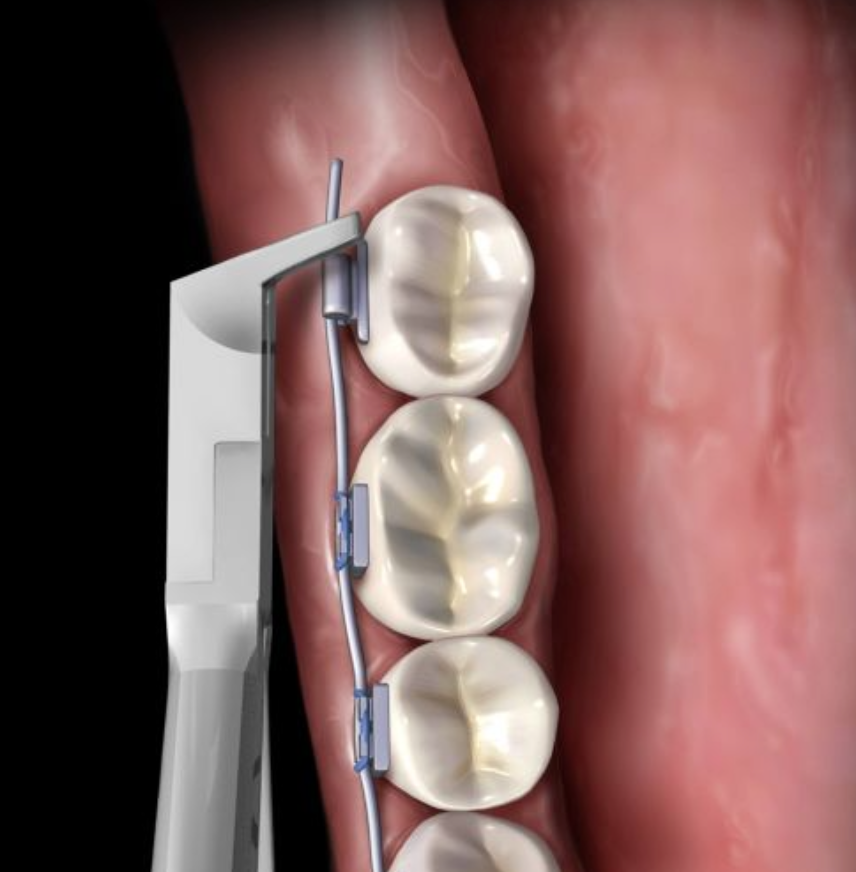 PINZA/ALICATE DE CORTE DISTAL DELGADA CON GOMA Y SEGURO HU-FRIEDY