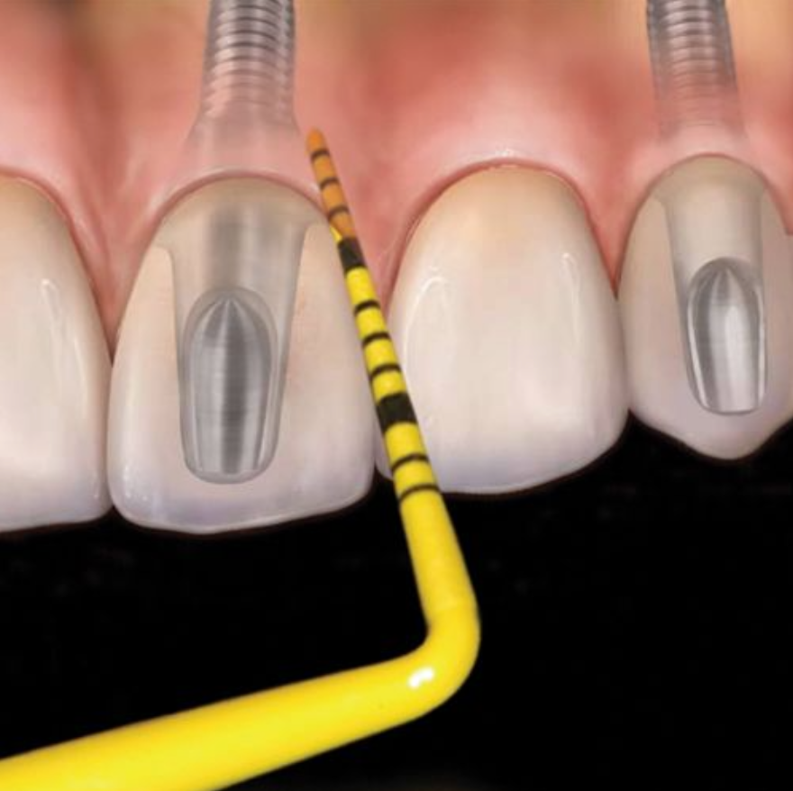 REPUESTOS SONDA COLORVUE AMARILLA CAROLINA DEL NORTE 12MM CON 12 PUNTAS HU-FRIEDY