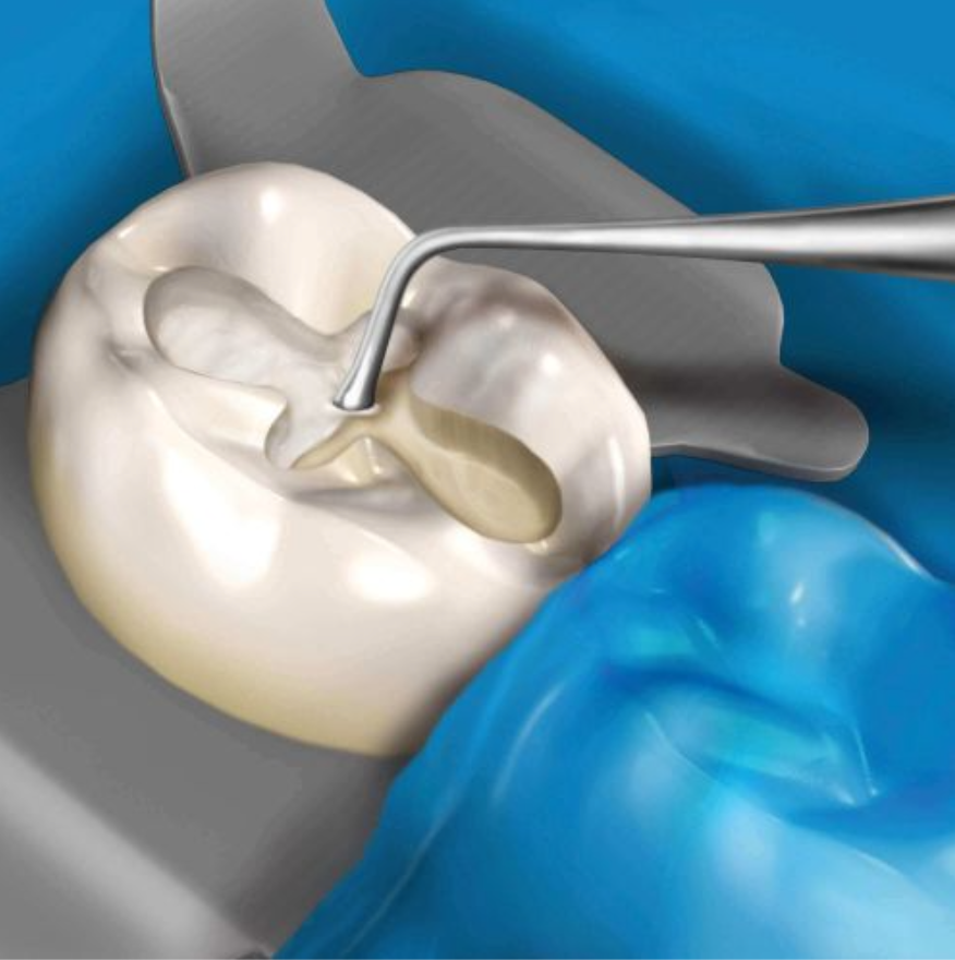 APLICADOR PLANO DE CEMENTO/MEDICAMENTO NOVATECH 11 HU-FRIEDY