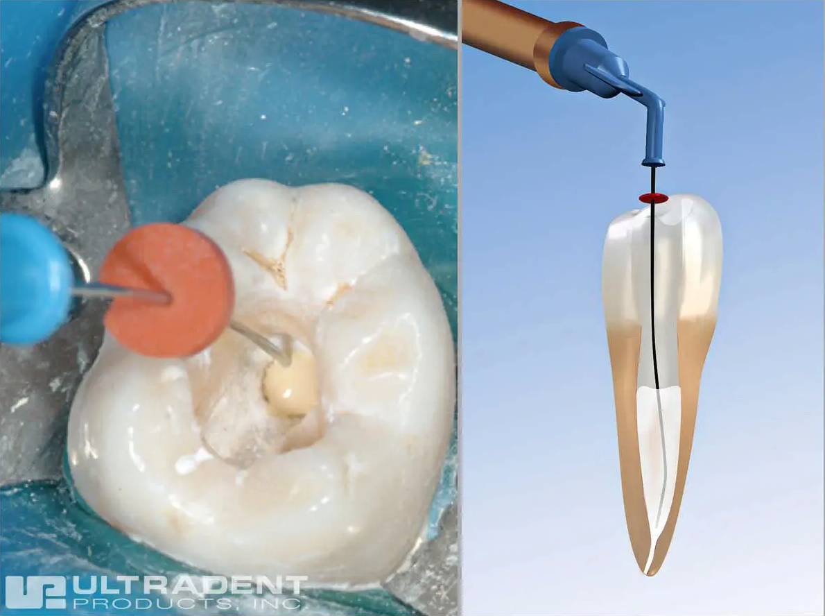 ENDO-EZE NAVITIP