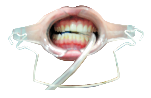 RETRACTOR DE LABIOS