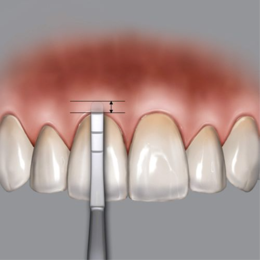 SONDA PARA CRESTA ALVEOLAR DR. CHU«S METALICA HU-FRIEDY