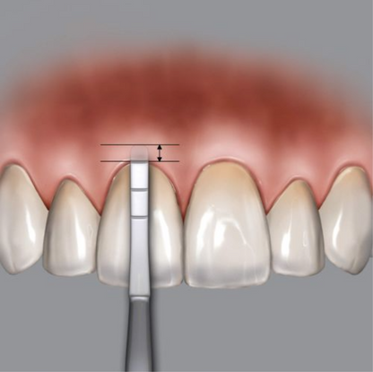 SONDA PARA CRESTA ALVEOLAR DR. CHU«S METALICA HU-FRIEDY