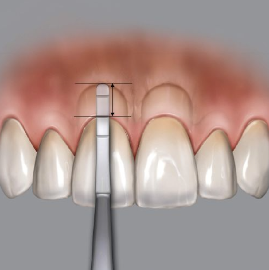 SONDA PARA CRESTA ALVEOLAR DR. CHU«S METALICA HU-FRIEDY