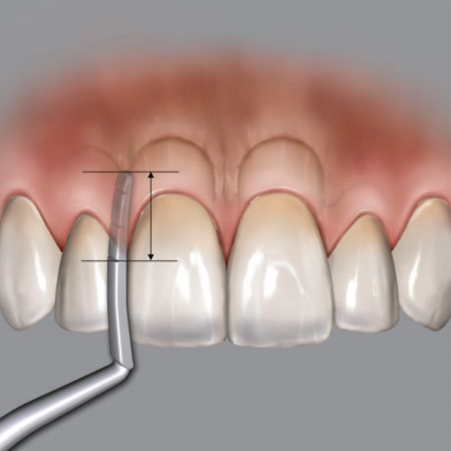 SONDA PARA CRESTA ALVEOLAR DR. CHU«S METALICA HU-FRIEDY