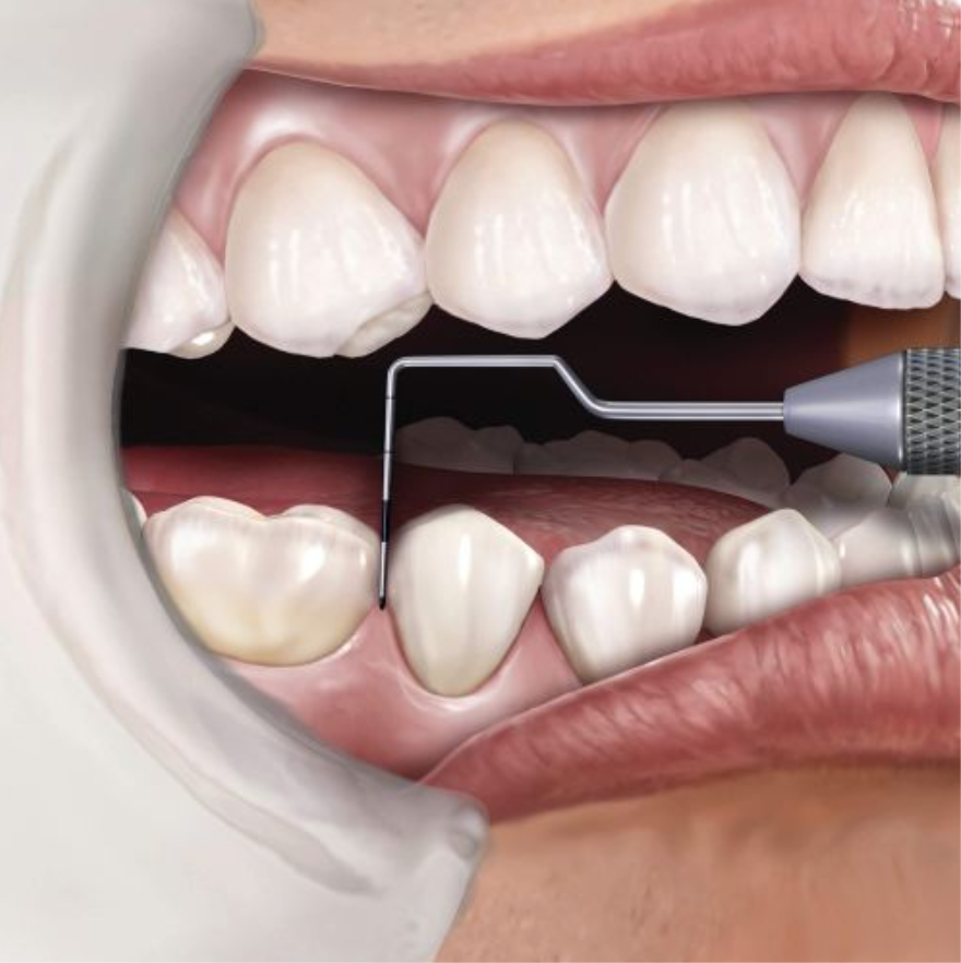 SONDA NOVATECH CP12 CODIFICADA MANGO 6 HU-FRIEDY