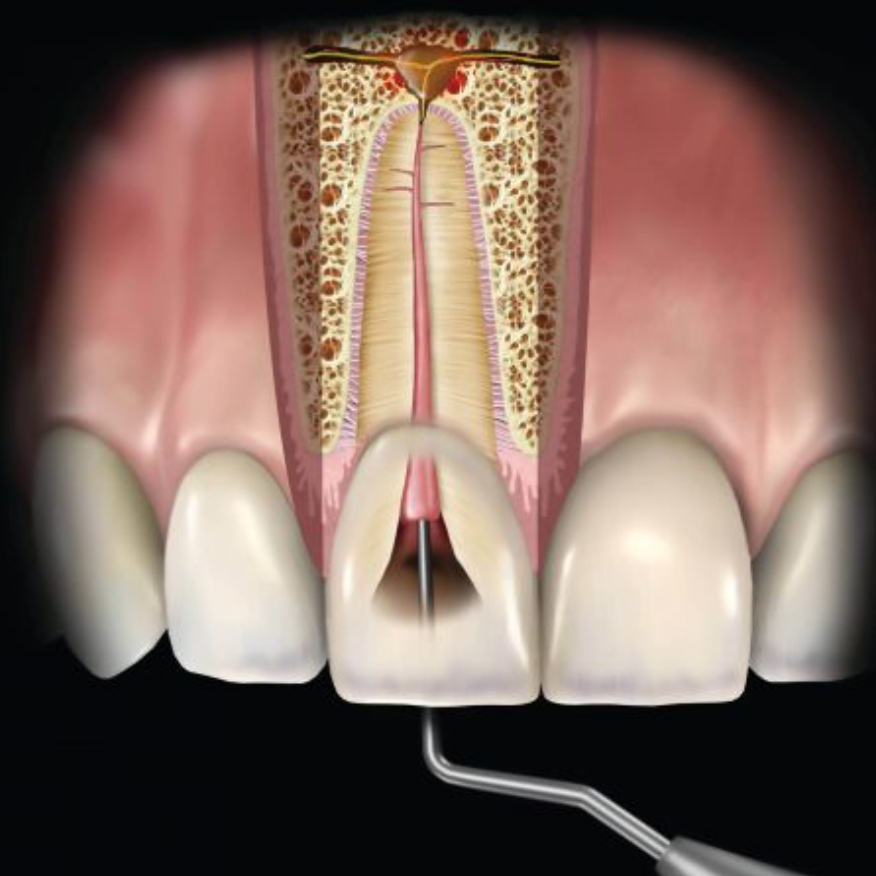CONDENSADOR DE CONDUCTO RADICULAR SLEIMAN #1 HU-FRIEDY