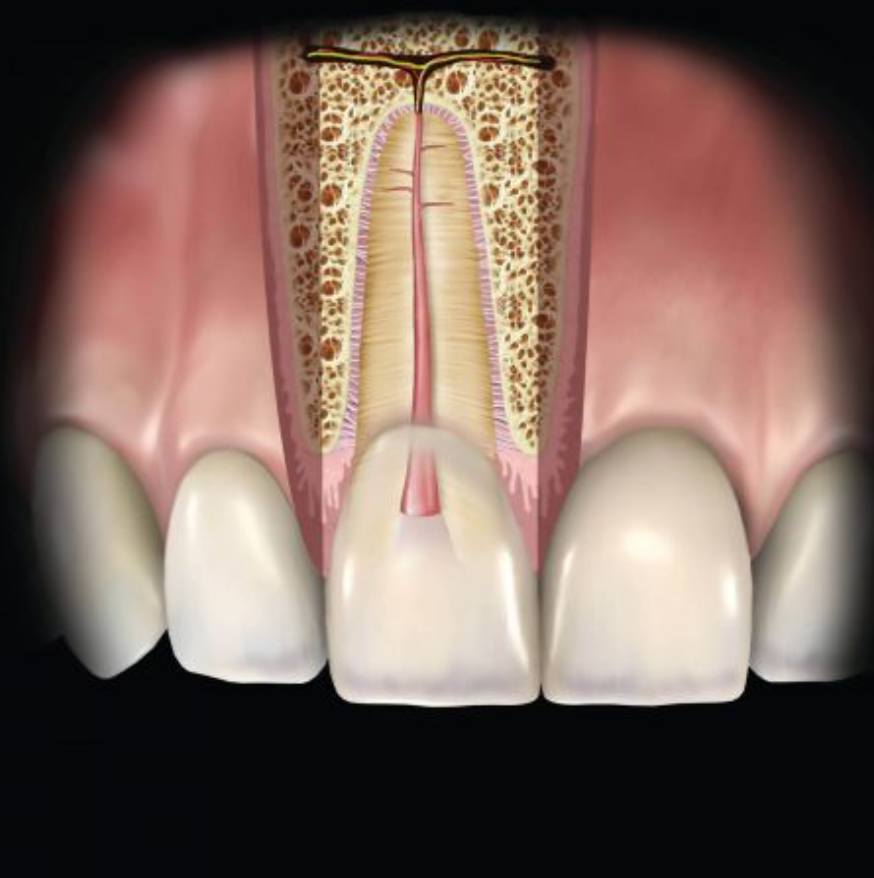 CONDENSADOR DE CONDUCTO RADICULAR SLEIMAN #1 HU-FRIEDY