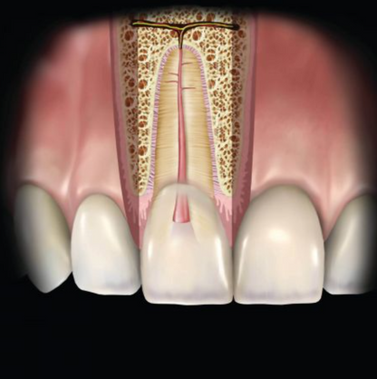 CONDENSADOR DE CONDUCTO RADICULAR SLEIMAN #1 HU-FRIEDY