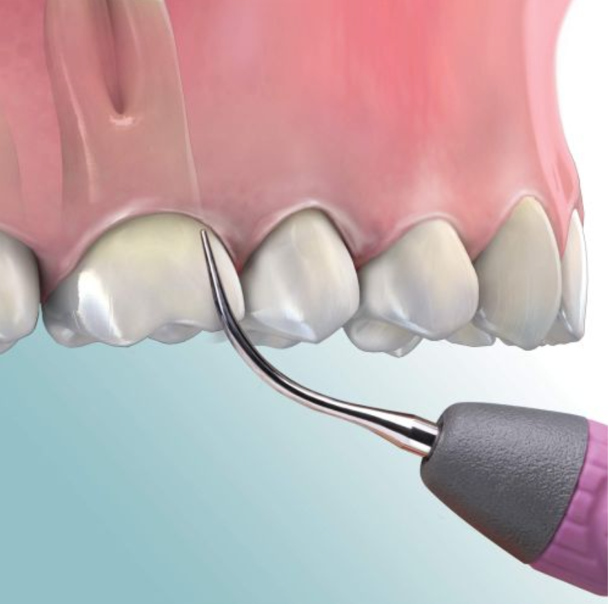 INSERTO ULTRASONICO 30K/SD10 UNIVERSAL MANGO GIRATORIO (ROSA/GRIS) HU-FRIEDY